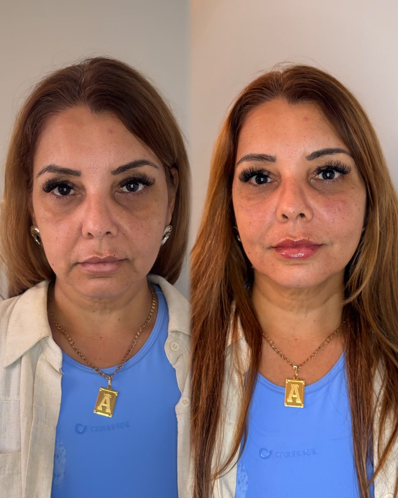 Protocolo MC REJUVE para rejuvenescimento facial